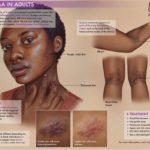 Handdrawn image resembling a poster in a doctor's office depicting the face, elbow, and knees of a black person living with eczema 